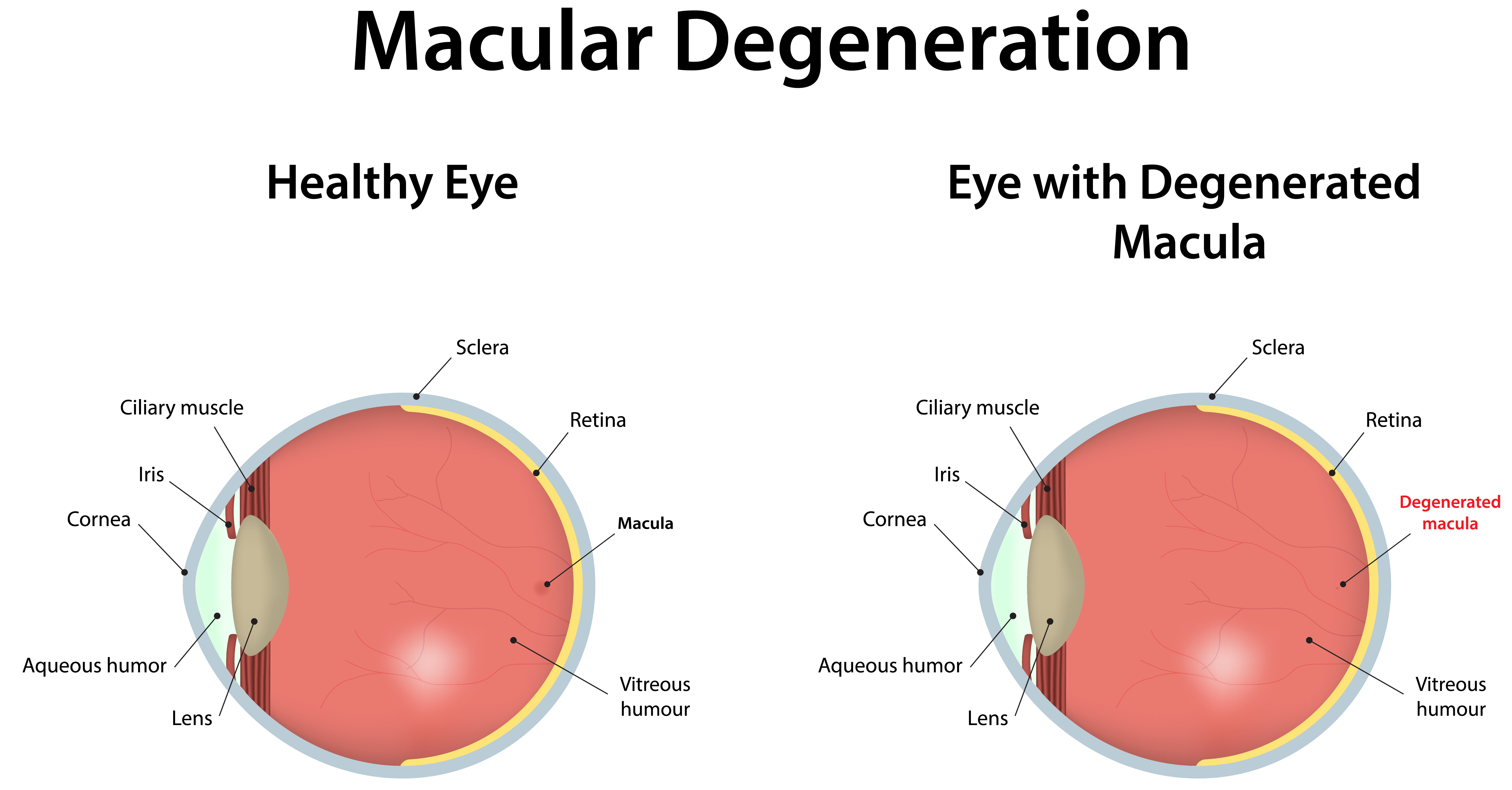 macular degeneration.jpg